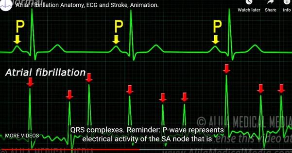 Revolutionizing Health Care: Atrial fibrillation anatomy, ECG and stroke animation