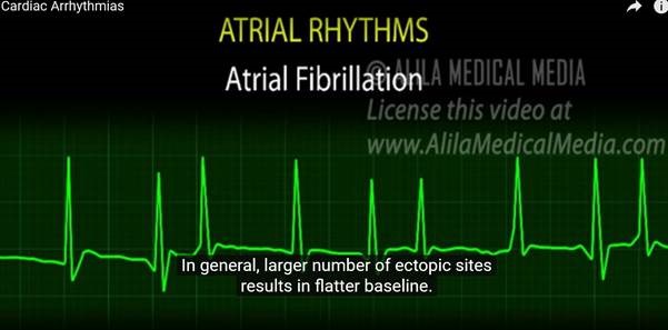 Revolutionizing Health Care: Atrial fibrillation monitoring